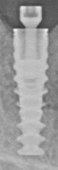 Nobel Active-Internal connection NP (3.5)